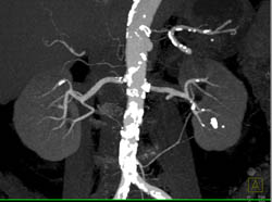 Vascular Calcifications in the Renal Arteries - CTisus CT Scan