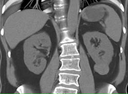 Papillary Renal Cell Carcinoma- Left Kidney - CTisus CT Scan