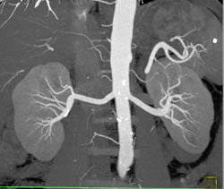 Normal Renal Arterial Anatomy and Branching - CTisus CT Scan