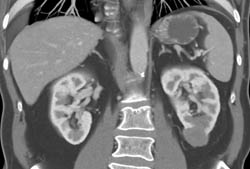 High Density Renal Cyst - CTisus CT Scan