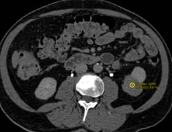 High Density Renal Cyst - CTisus CT Scan