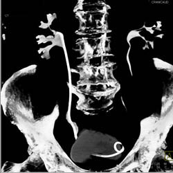 Transitional Cell Carcinoma Upper Pole Right Kidney - CTisus CT Scan