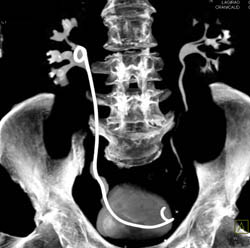 Transitional Cell Carcinoma - CTisus CT Scan