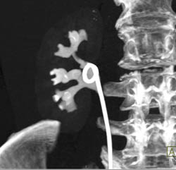 Transitional Cell Carcinoma - CTisus CT Scan