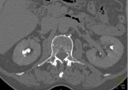 Transitional Cell Carcinoma - CTisus CT Scan