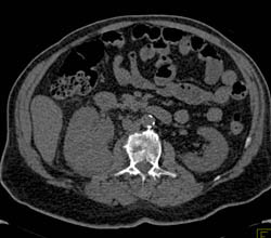 Tumor Infiltration of the Right Kidney- Transitional Cell Carcinoma - CTisus CT Scan