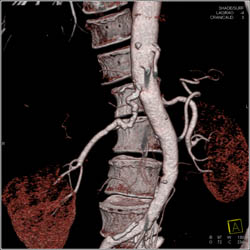 Fibromuscular Dysplasia (FMD) of Right Renal Artery - CTisus CT Scan