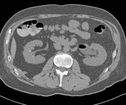 Air in Left Ureter and Renal Pelvis - CTisus CT Scan