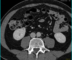 1 Cm Renal Cell Carcinoma With Liver Metastases - CTisus CT Scan