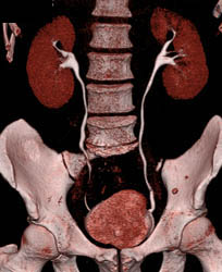 Ct Urogram - CTisus CT Scan