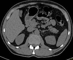 1 Cm Renal Cell Carcinoma - CTisus CT Scan