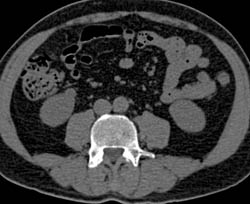 1 Cm Renal Cell Carcinoma - CTisus CT Scan