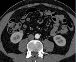 1 Cm Renal Cell Carcinoma - CTisus CT Scan