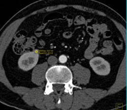 1 Cm Renal Cell Carcinoma - CTisus CT Scan