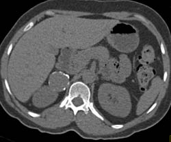 Renal Artery Aneurysm - CTisus CT Scan