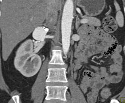 Renal Artery Aneurysm - CTisus CT Scan