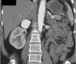 Renal Artery Aneurysm - CTisus CT Scan