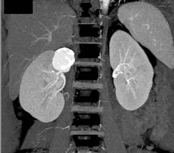 Renal Artery Aneurysm - CTisus CT Scan