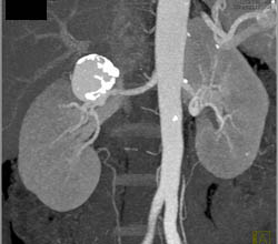 Renal Artery Aneurysm - CTisus CT Scan