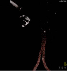 Renal Artery Aneurysm - CTisus CT Scan