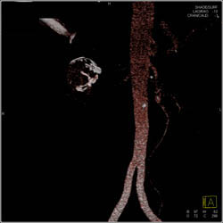 Renal Artery Aneurysm - CTisus CT Scan