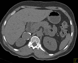 Renal Artery Aneurysm - CTisus CT Scan