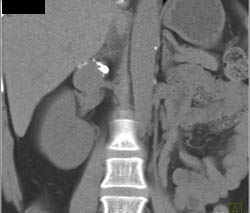 Renal Artery Aneurysm - CTisus CT Scan