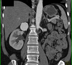 Renal Artery Aneurysm - CTisus CT Scan