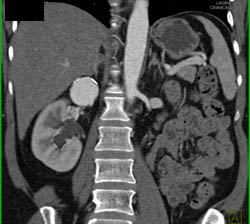 Renal Artery Aneurysm - CTisus CT Scan