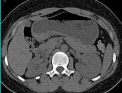 Scarring Right Kidney Due to Chronic Pyelonephritis - CTisus CT Scan