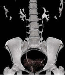 Partially Duplicated Right Collecting System - CTisus CT Scan