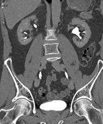 Duplicated Right Collecting System With CT Urogram - CTisus CT Scan