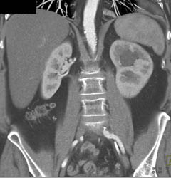 Acute Pyelonephritis With Dilated Collecting System - CTisus CT Scan