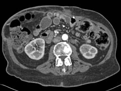 Acute Pyelonephritis With Left Renal Calculus - CTisus CT Scan