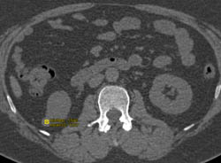 High Density Renal Cyst - CTisus CT Scan