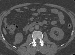 High Density Renal Cyst - CTisus CT Scan