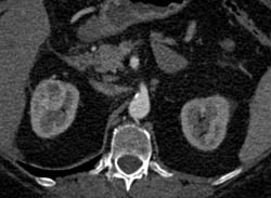 Renal Cell Carcinoma - CTisus CT Scan