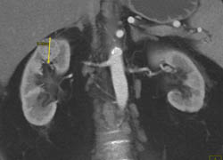 Subtle Renal Cell Carcinoma (RCC) on 3D Map - CTisus CT Scan