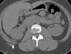 Chronic Pyelonephritis With Stone and Stent - CTisus CT Scan