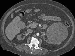 Renal Cyst With Tiny Nodule - CTisus CT Scan