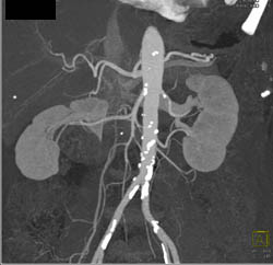 Renal Donor With 2 Left Renal Arteries - CTisus CT Scan