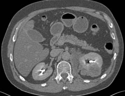 Unusual GIST Tumor of the Kidney and Perirenal Space - CTisus CT Scan