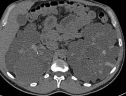 Polycystic Kidney Disease With High Density Renal Cysts - CTisus CT Scan