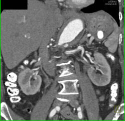 Dissection Extends Into Left Renal Artery - CTisus CT Scan