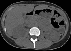 Subtle Acute Pyelonephritis- See Full Scan Sequence With All Phases - CTisus CT Scan