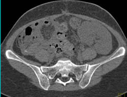 Acute Pyelonephritis in A Transplant Kidney - CTisus CT Scan