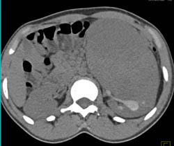 Unusual Renal Mass- RSNA Film Panel 2008 Diagnosis of Fibrous Tumor of the Kidney - CTisus CT Scan