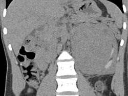 Unusual Renal Mass- RSNA Film Panel 2008 Diagnosis of Fibrous Tumor of the Kidney - CTisus CT Scan