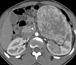 Unusual Renal Mass- RSNA Film Panel 2008 Diagnosis of Fibrous Tumor of the Kidney - CTisus CT Scan