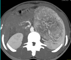 Unusual Renal Mass- RSNA Film Panel 2008 Diagnosis of Fibrous Tumor of the Kidney - CTisus CT Scan